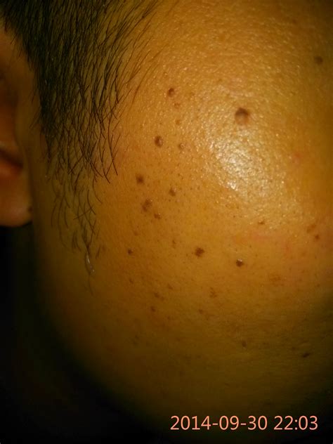 面上有黑斑|黑斑 (Melasma)